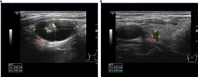 Unusual coexistence: branchial cleft cyst harboring papillary thyroid carcinoma with lymph node metastasis — a rare case report and clinical insights